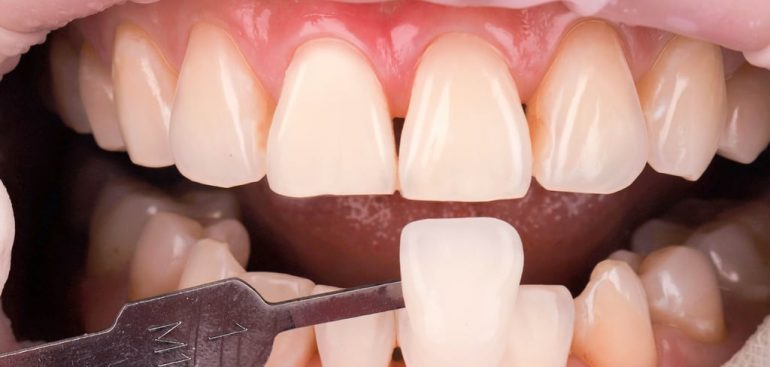 前牙美學專家-沈志容醫師推薦案例-網紅克萊兒牙齒美白全記錄-美白後變成M1