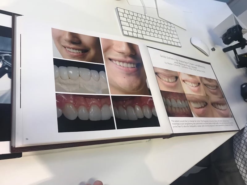 牙齒美白-香港牙醫價格-台灣全瓷冠瓷牙貼片推薦-香港謝德安醫師牙齒美白牙科美學案例