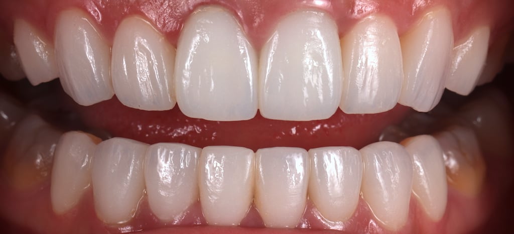 瓷牙貼片價格-牙齒貼片缺點-牙齒美白推薦診所選擇-使用德國大廠Dentsply Sirona的Celtra Duo-顏色雪白自然