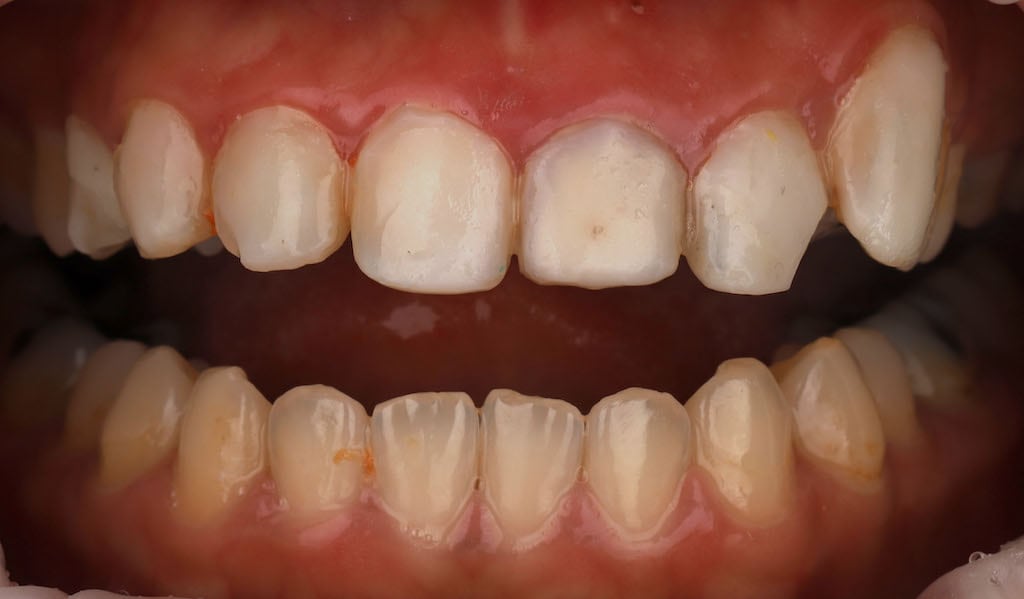 瓷牙貼片價格-牙齒貼片缺點-牙齒美白推薦診所選擇-密醫工作室的樹脂貼片大小不對稱-多處破損染色-牙齦發炎
