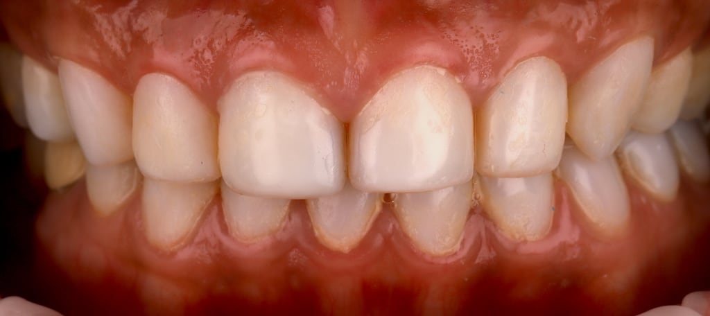 瓷牙貼片價格-牙齒貼片缺點-牙齒美白推薦診所選擇-密醫美白工作室的樹脂貼片造成上下排牙齦發炎
