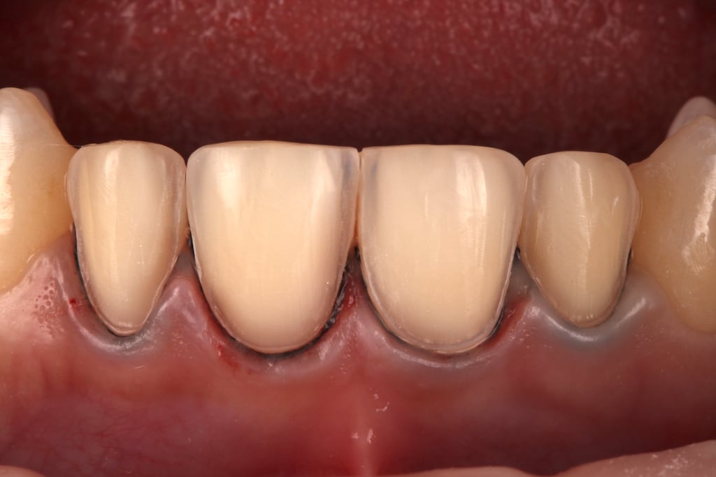 瓷牙貼片價格-牙齒貼片缺點-牙齒美白推薦診所選擇-顯微鏡下研磨的前門牙四顆貼片