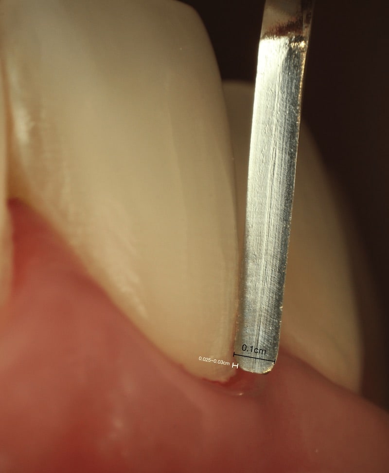 瓷牙貼片價格，顯微微創超薄磨牙，牙齒美白貼片推薦，牙齒貼片缺點-牙齒美白推薦診所選擇-琺瑯質研磨的量僅約0.025cm-非常微創的操作