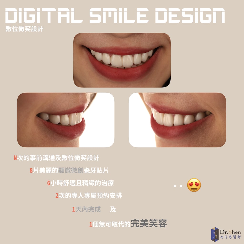 DSD數位微笑設計-桃園-陶瓷貼片-完美微笑曲線-一日美齒-牙齒美白