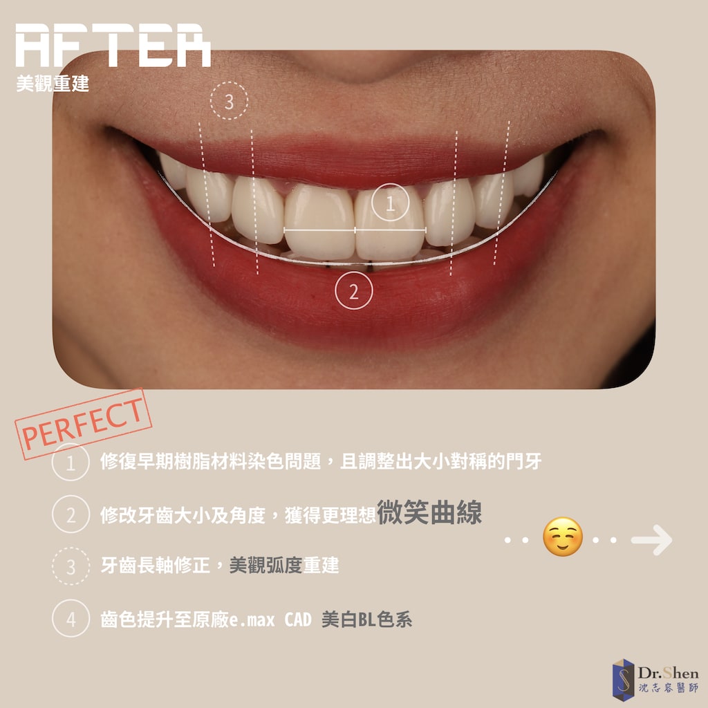 完美微笑曲線-DSD數位微笑設計-陶瓷貼片-牙齒美白貼片-樹脂染色-桃園牙齒美白