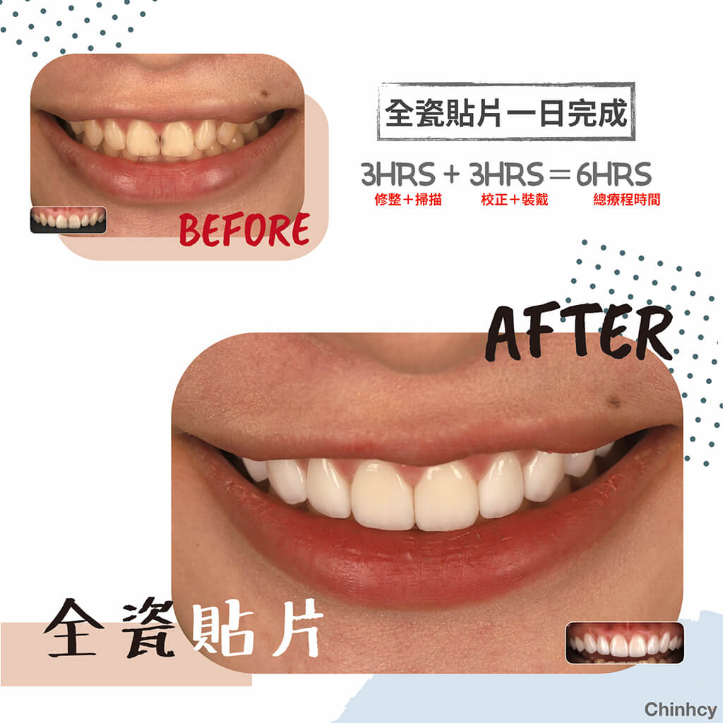 陶瓷貼片-韓沁渝-明星-藝人-牙齒美白-療程前後比較-沈志容醫師-桃園