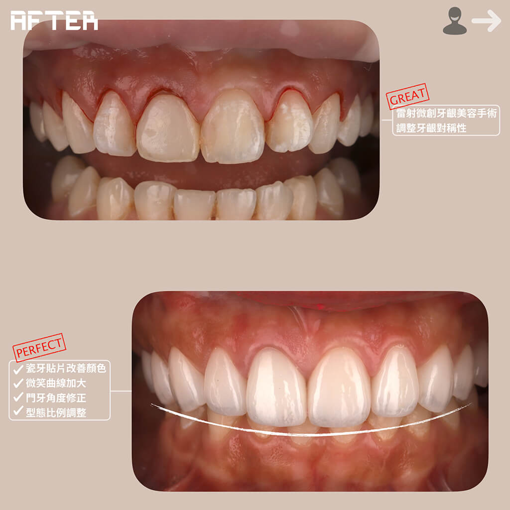 雷射牙齦美容手術-調整牙齦對稱性-dsd數位微笑設計-微笑曲線-瓷牙貼片-一日美齒-桃園牙齒美白