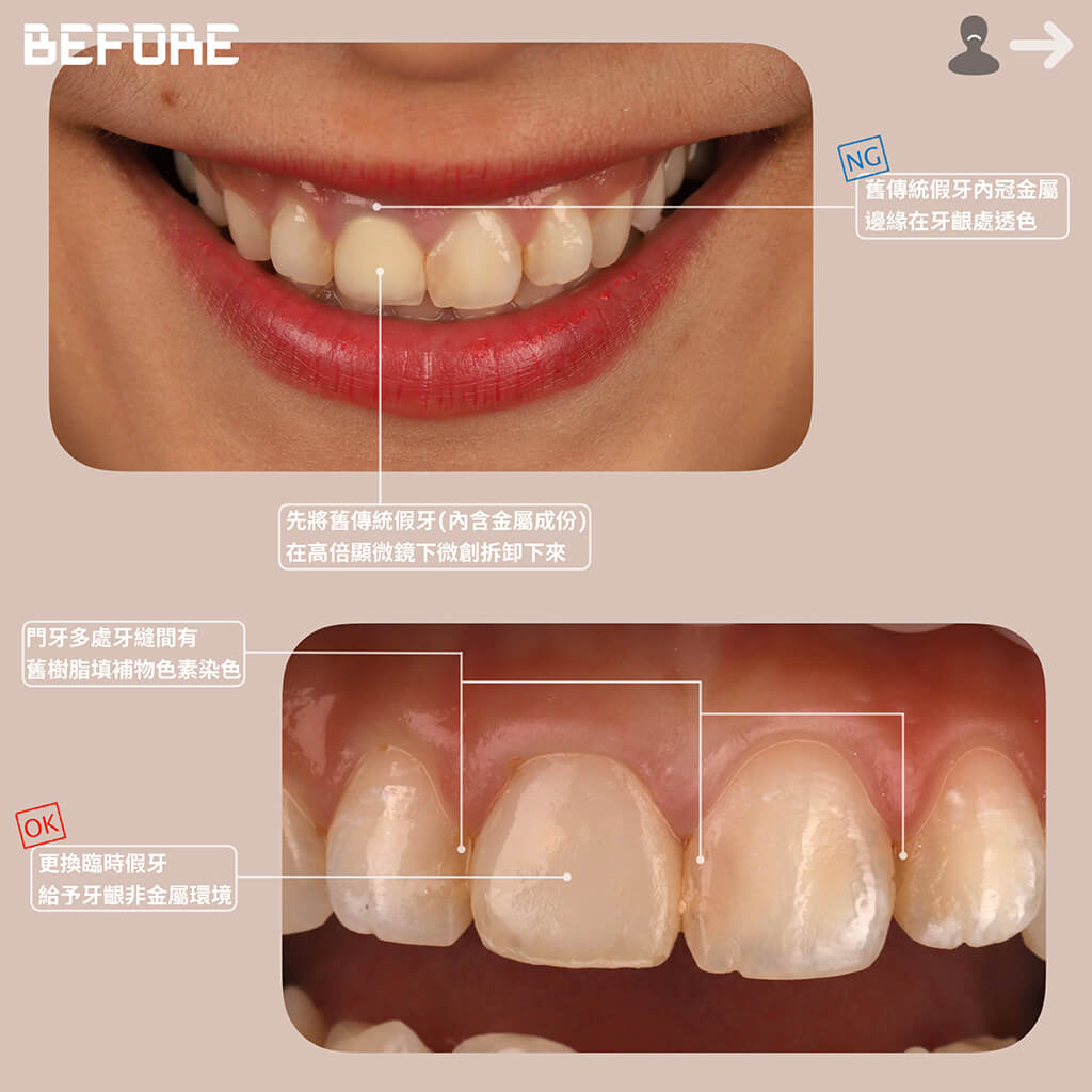 瓷牙貼片修正舊假牙金屬邊緣透色-門牙樹脂補牙染色-dsd數位微笑設計-微笑曲線-瓷牙貼片-一日美齒-桃園牙齒美白色