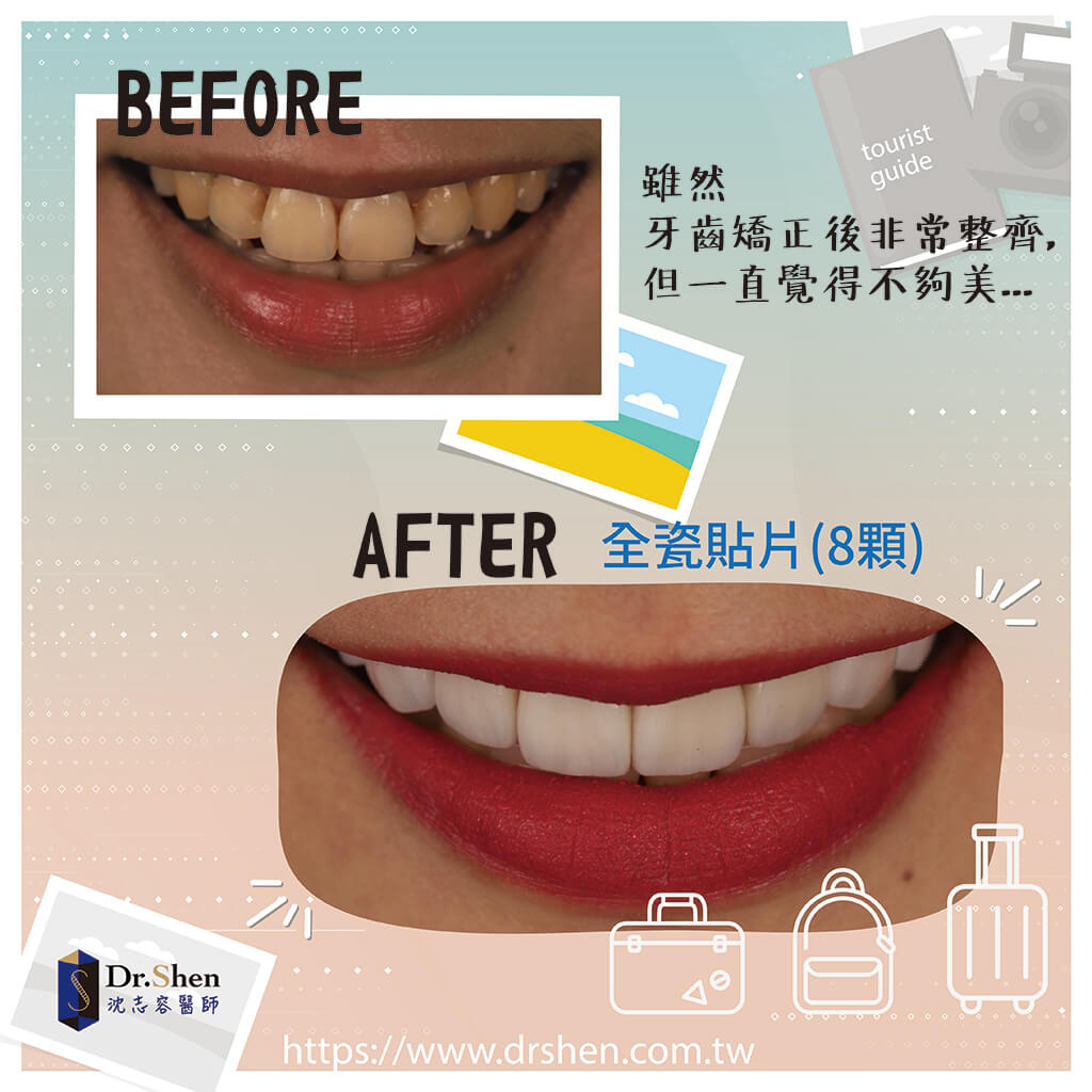 陶瓷貼片療程前後對比-瓷牙貼片-一日美齒-牙齒美白-DSD數位微笑設計-完美微笑曲線