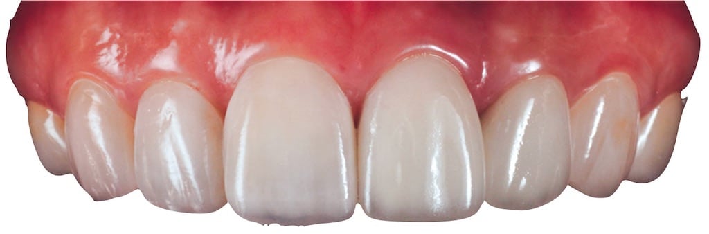 陶瓷貼片-推薦-桃園牙齒美白-沈志容醫師-DSD數位微笑設計-其他院所完成DSD數位微笑的瓷牙貼片