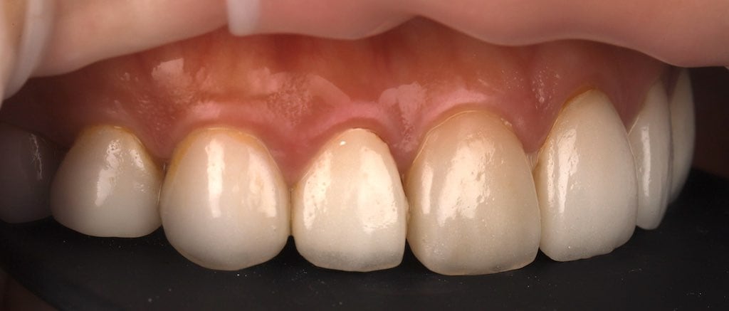 陶瓷貼片-推薦-桃園牙齒美白-沈志容醫師-DSD數位微笑設計-其他院所的瓷牙貼片-右側45度角-門牙貼片變色