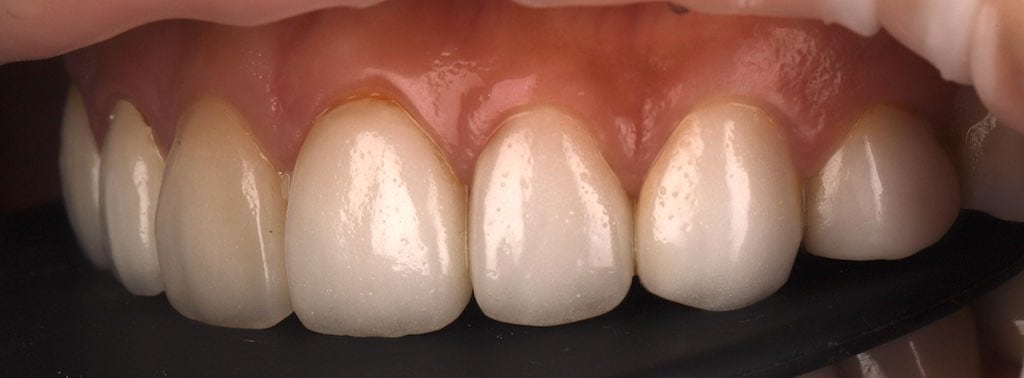 陶瓷貼片-推薦-桃園牙齒美白-沈志容醫師-DSD數位微笑設計-其他院所的瓷牙貼片-左側45度角-貼片表面氣泡