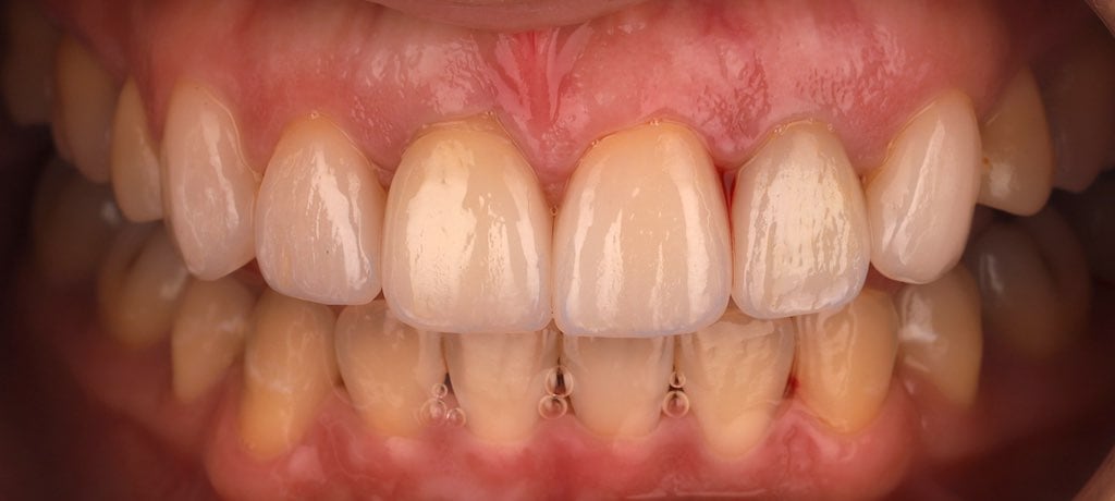 陶瓷貼片-推薦-桃園牙齒美白-沈志容醫師-DSD數位微笑設計-其他院所的瓷牙貼片-正面