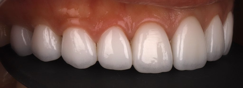 陶瓷貼片-推薦-桃園牙齒美白-沈志容醫師-DSD數位微笑設計-完成的瓷牙貼片-右側45度角