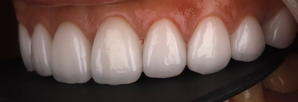 陶瓷貼片-推薦-桃園牙齒美白-沈志容醫師-DSD數位微笑設計-完成的瓷牙貼片-左側45度角