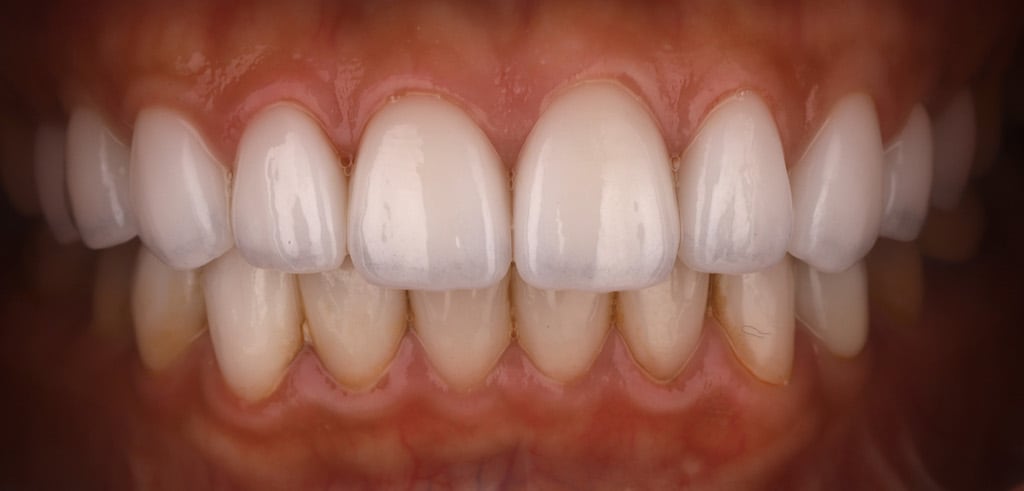陶瓷貼片-推薦-桃園牙齒美白-沈志容醫師-DSD數位微笑設計-更換上排門牙的瓷牙貼片