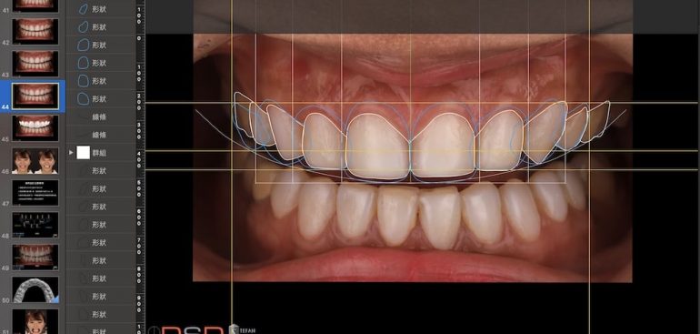 陶瓷貼片-推薦-桃園牙齒美白-沈志容醫師-DSD數位微笑設計-沈醫師親自設計每位患者的報告