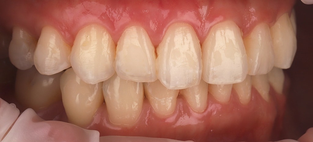 瓷牙貼片-陶瓷貼片-台灣牙齒美白推薦-海外-新加坡-Vivian治療前口內照-右