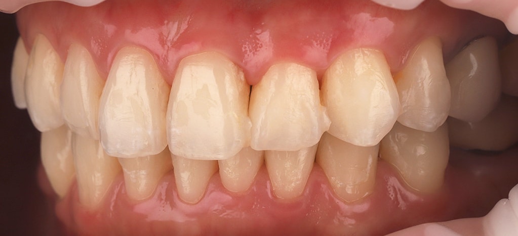 瓷牙貼片-陶瓷貼片-台灣牙齒美白推薦-海外-新加坡-Vivian治療前口內照-左