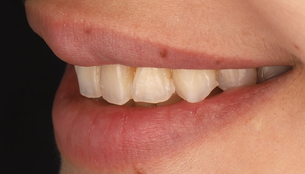 瓷牙貼片-陶瓷貼片-台灣牙齒美白推薦-海外-新加坡-Vivian治療前口外照-左