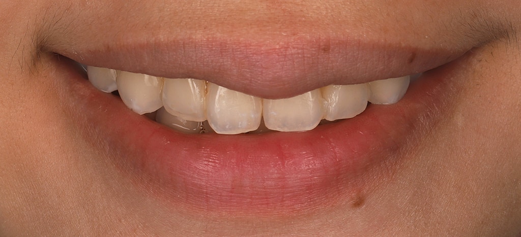 瓷牙貼片-陶瓷貼片-台灣牙齒美白推薦-海外-新加坡-Vivian治療前口外照-正面