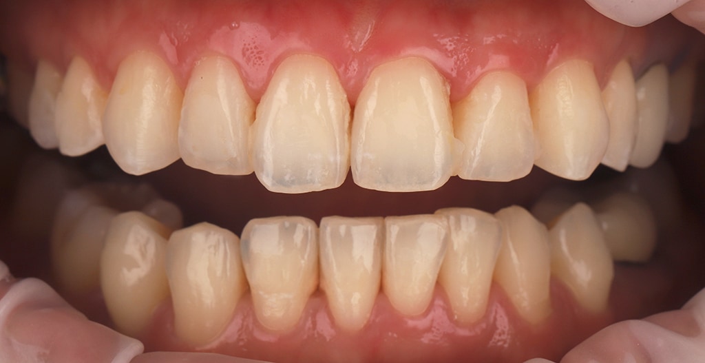 瓷牙貼片-陶瓷貼片-台灣牙齒美白推薦-海外-新加坡-Vivian治療前的口內狀況