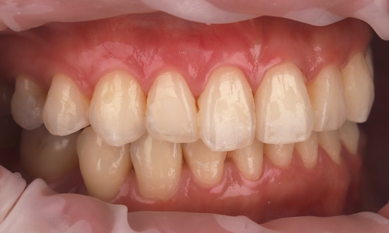 瓷牙貼片-陶瓷貼片-台灣牙齒美白推薦-海外-新加坡-Vivian瓷牙貼片術前術後對比-右側-術前