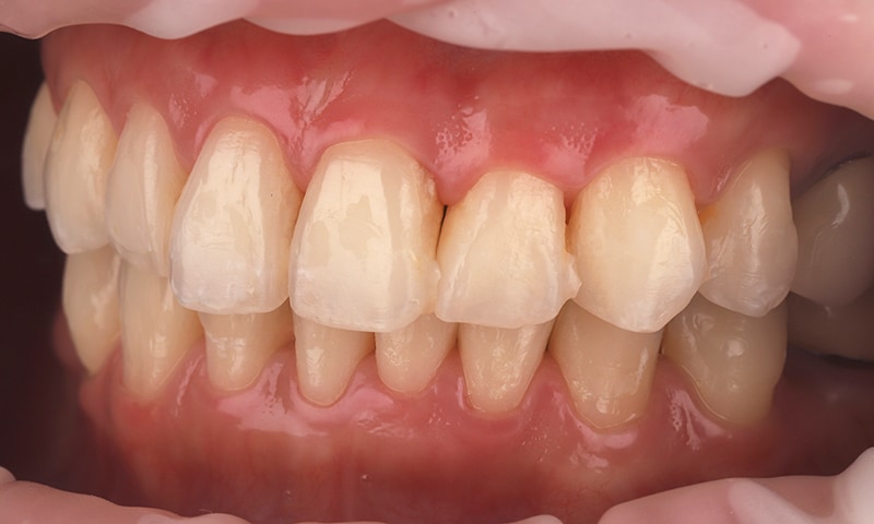 瓷牙貼片-陶瓷貼片-台灣牙齒美白推薦-海外-新加坡-Vivian瓷牙貼片術前術後對比-左側-術前