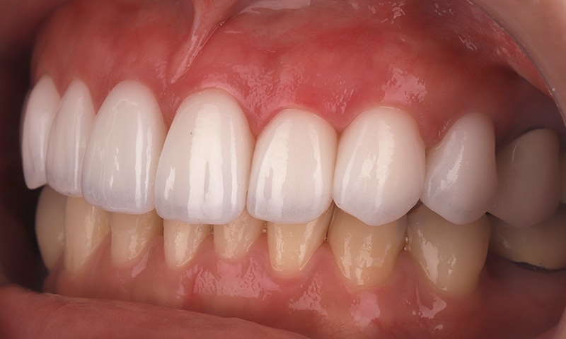 瓷牙貼片-陶瓷貼片-台灣牙齒美白推薦-海外-新加坡-Vivian瓷牙貼片術前術後對比-左側-術後