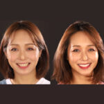 DSD數位微笑設計流程-3-試戴笑容，即時模擬調整-沈志容醫師-桃園