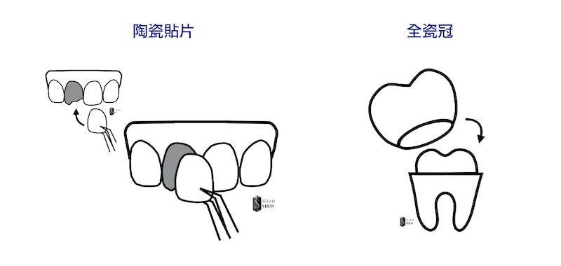 陶瓷貼片與全瓷冠的比較示意圖