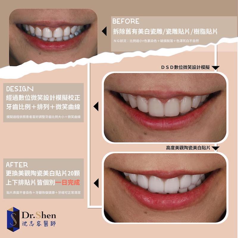 瓷牙貼片後遺症有哪些 超後悔做免磨牙瓷牙貼片 為什麼 專家告訴你