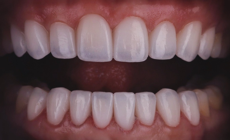 牙齒矯正-陶瓷貼片-中度-牙齒不整齊-下排牙齒亂-全瓷冠修復後-沈志容醫師-桃園