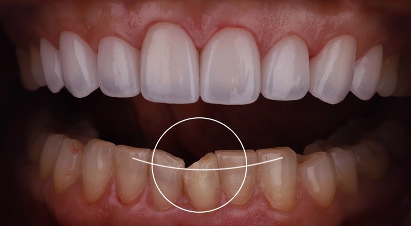 牙齒矯正-陶瓷貼片-中度-牙齒不整齊-下排牙齒亂-療程前-沈志容醫師-桃園