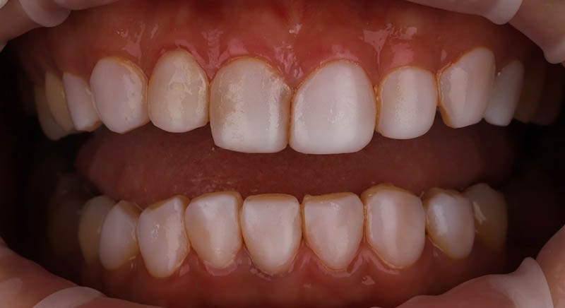 牙齒矯正-陶瓷貼片-樹脂貼片-牙齒貼片失敗-牙齦發炎-沈志容醫師-桃園