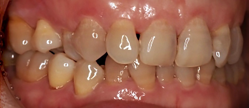 牙齒矯正-陶瓷貼片-牙齒排列嚴重不整齊-牙齒擁擠-沈志容醫師-桃園