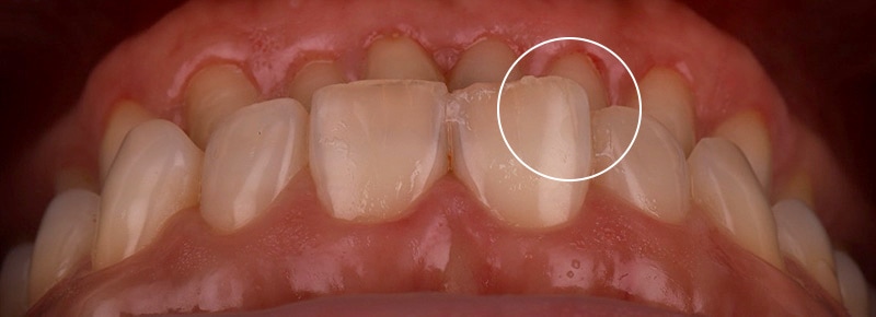 牙齒矯正-陶瓷貼片-輕微-牙齒不整齊-上排牙齒俯視照-療程前-沈志容醫師-桃園