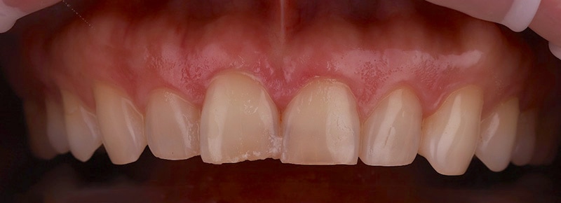 牙齒矯正-陶瓷貼片-輕微-牙齒不整齊-上排牙齒正面照-療程前-沈志容醫師-桃園