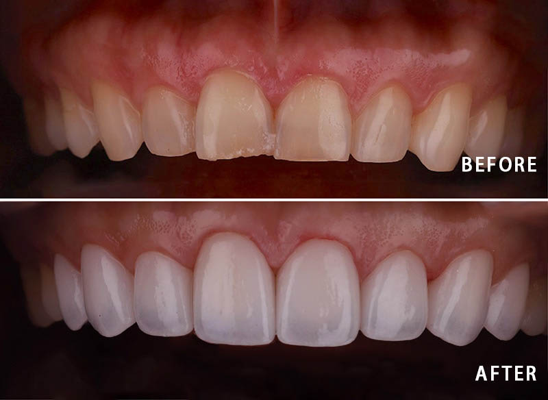 牙齒矯正-陶瓷貼片-輕微-牙齒不整齊-上排牙齒正面照-療程前後比較-沈志容醫師-桃園