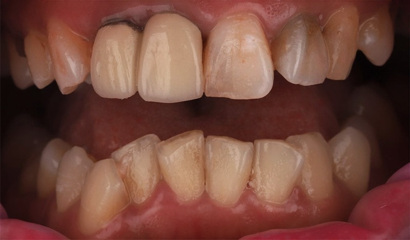 牙齒矯正-陶瓷貼片-重度-牙齒不整齊-無法用瓷牙貼片-沈志容醫師-桃園
