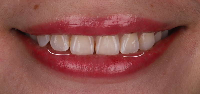 陶瓷貼片-牙齒矯正後-左右側門牙長度比較-沈志容醫師-桃園