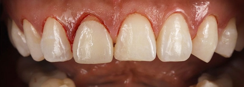 陶瓷貼片-牙齒矯正後-水雷射-牙齦整形-沈志容醫師-桃園