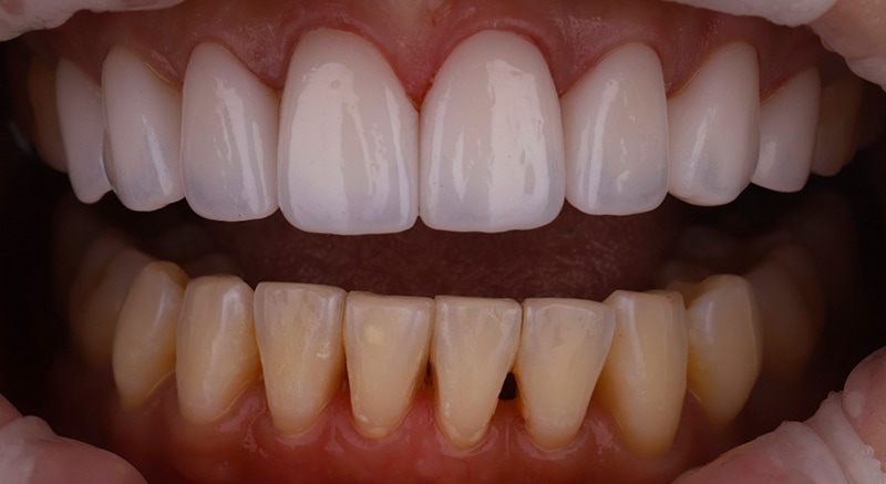 陶瓷貼片-牙齒矯正後-牙縫大-上排陶瓷貼片-下排牙齒黑三角-比較-沈志容醫師-桃園