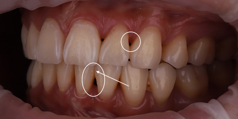 陶瓷貼片-牙齒矯正後-牙縫大-牙齒黑三角治療前-沈志容醫師-桃園