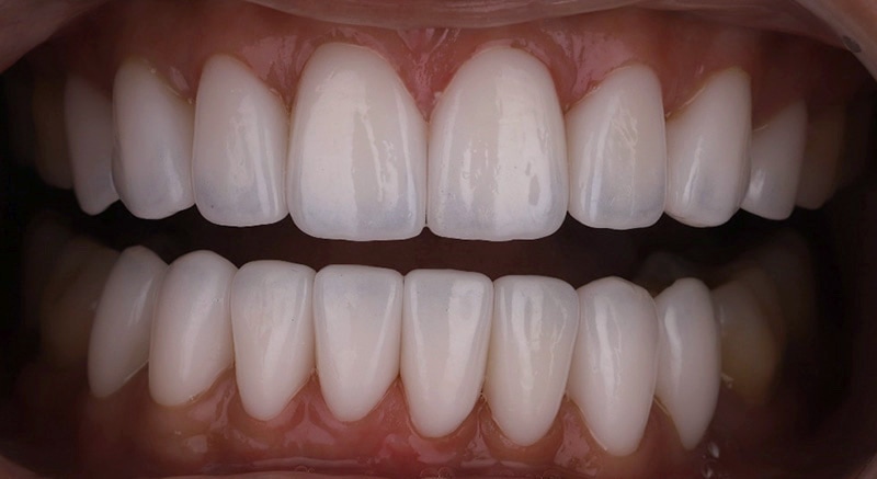 陶瓷貼片-牙齒矯正後-牙縫大-牙齒黑三角治療後-完成上下排瓷牙貼片-沈志容醫師-桃園