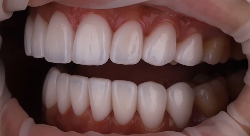陶瓷貼片-牙齒矯正後-牙縫大-牙齒黑三角治療後-沈志容醫師-桃園