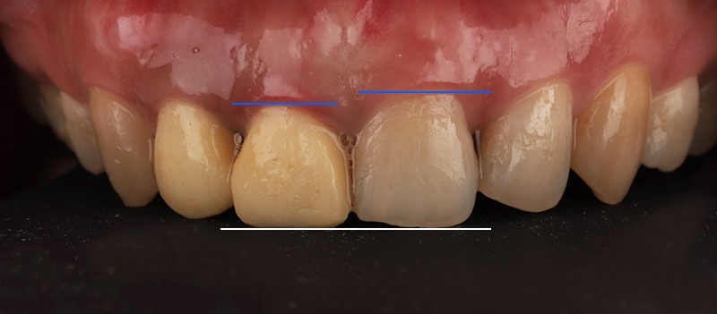 陶瓷貼片-牙齒矯正後-牙齒長度不一樣-牙齒正面照-沈志容醫師-桃園