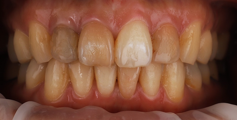 陶瓷貼片-牙齒矯正後-牙齒黃-牙齒顏色不均-療程前-沈志容醫師-桃園