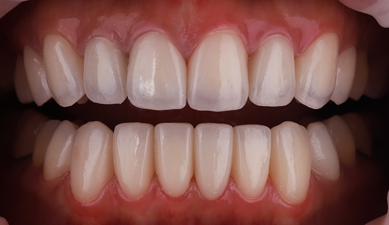 陶瓷貼片-牙齒矯正後-牙齒黃-牙齒顏色不均-療程後-沈志容醫師-桃園