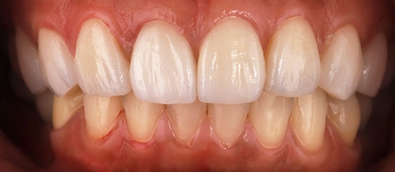 陶瓷貼片-牙齒矯正後-牙齦整形-瓷牙貼片-療程後-沈志容醫師-桃園